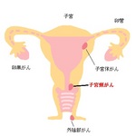 20歳代の増加が目立つ子宮頸がん